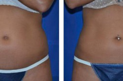 Liposonix Before-After