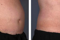 Liposonix Before-After