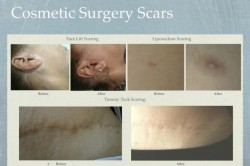 Scar & Stretch Mark Reduction Before-After
