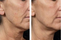 Fraxel Dual Laser Before-After