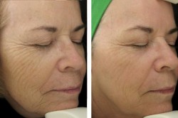 Fraxel Dual Laser Before-After