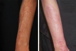 UltraPulse Encore CO2 Laser Arms Before-After