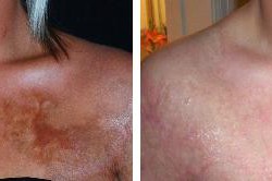 UltraPulse Encore CO2 Laser Chest Before-After