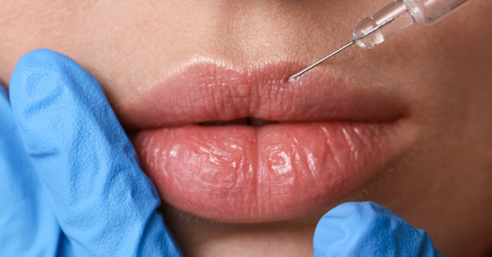 Close up of a woman receiving lip filler on her cupid’s bow by a gloved provider