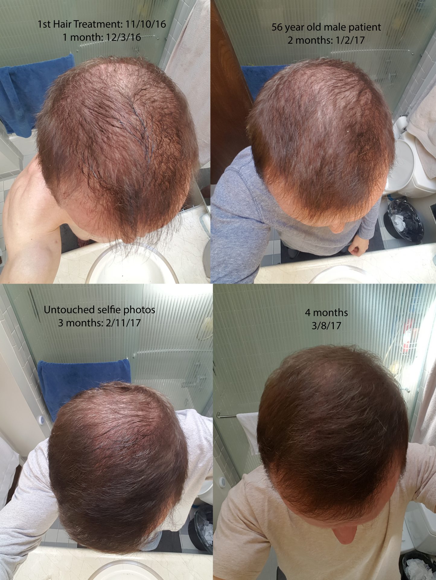 ACell + PRP Hair Regrowth Therapy Delivers Real Results - Serenity MedSpa