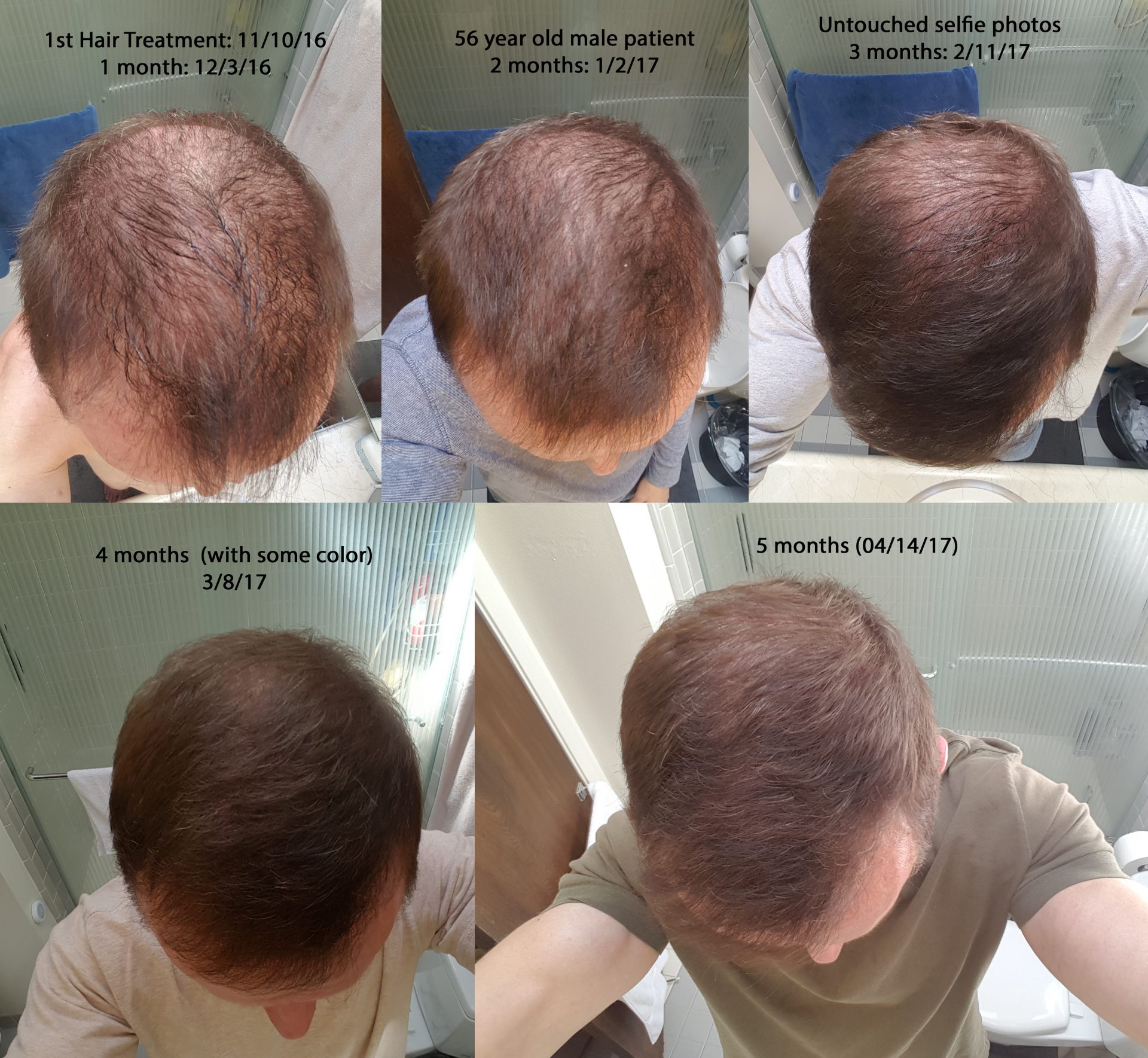ACell + PRP Hair Regrowth Therapy - Serenity MedSpa