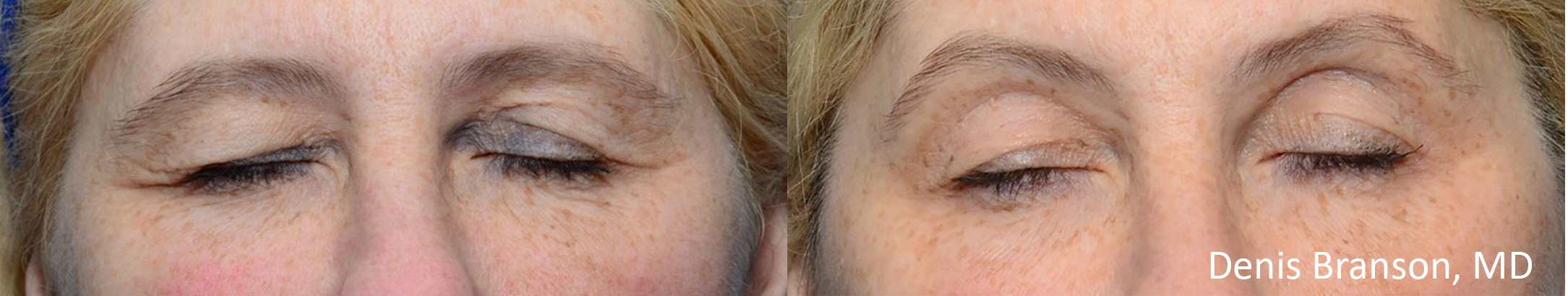 Thermismooth Db Eyes Before And After Serenity Medspa