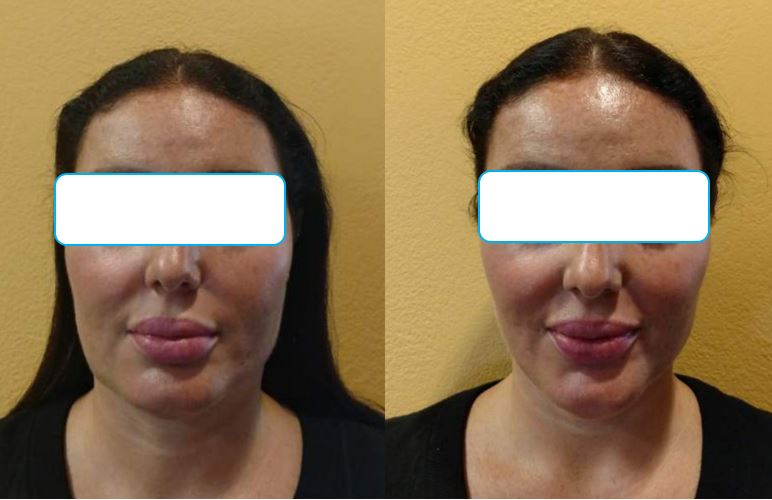 pdo thread lift jawline before and after