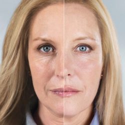 Sculptra Before-After